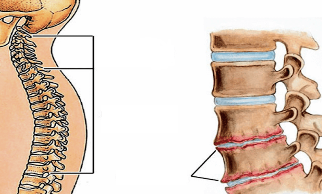 How do you see the osteochondrosis of the column