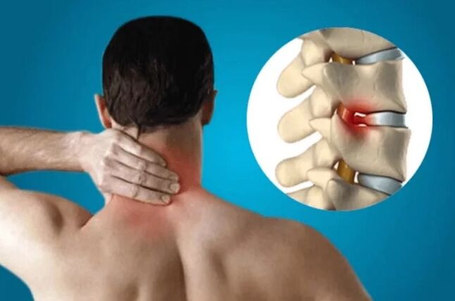 Column osteochondrosis
