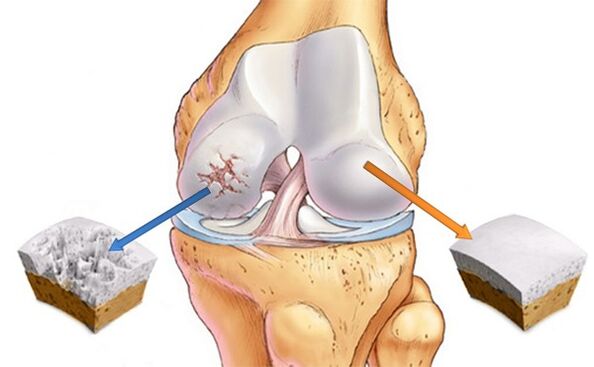 Healthy cartilage and cartilage affected by osteoarthritis.