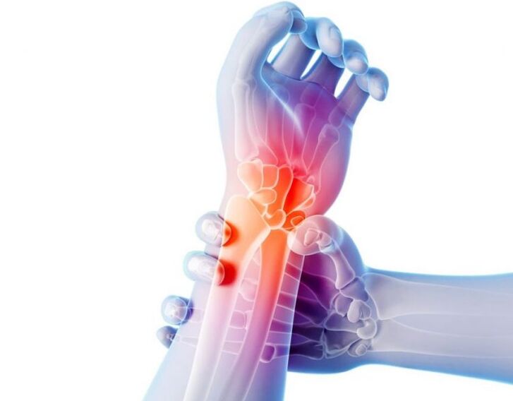 Osteoarthritis of the joints is accompanied by pain and requires complex treatment.