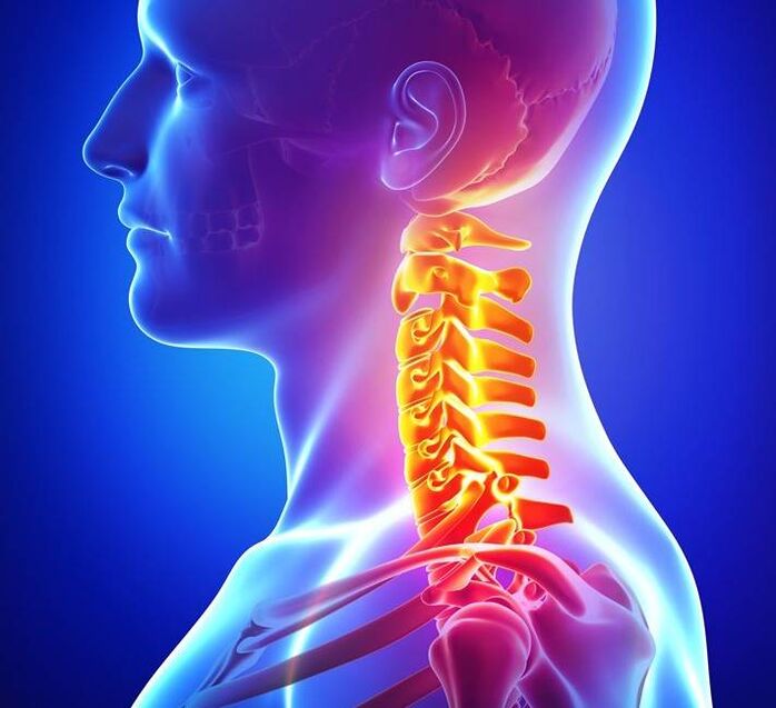 Osteochondrosis of the cervical spine. 