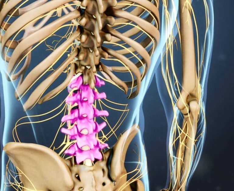 Osteochondrosis of the lumbar spine. 