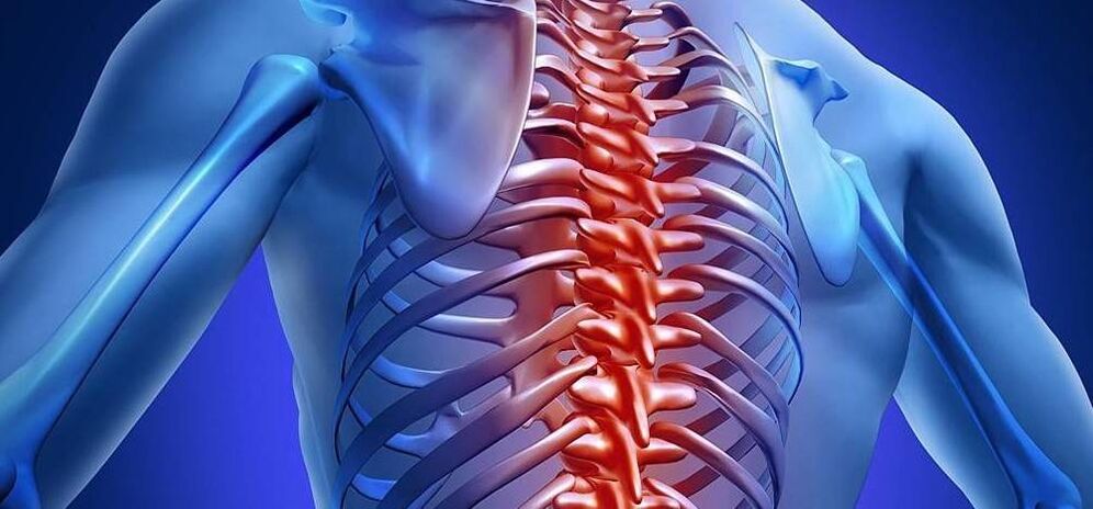 Osteochondrosis of the thoracic spine. 