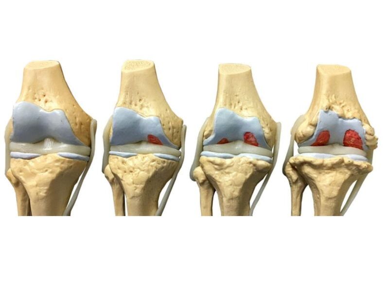 degree of osteoarthritis of the joints